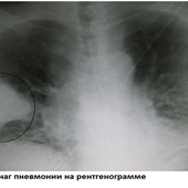 бактериальная пневмония фото