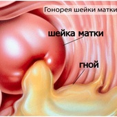 гонококковая инфекция мочеполового тракта нижних отделов фото